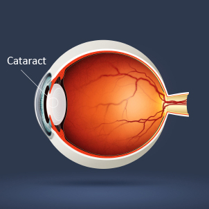Cataract Service
